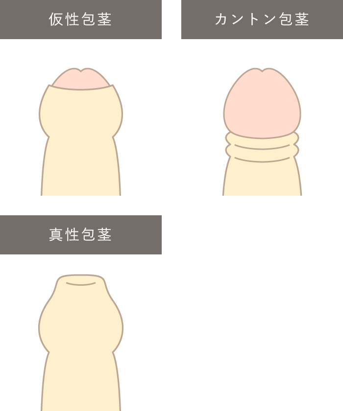 包茎の種類のイメージ