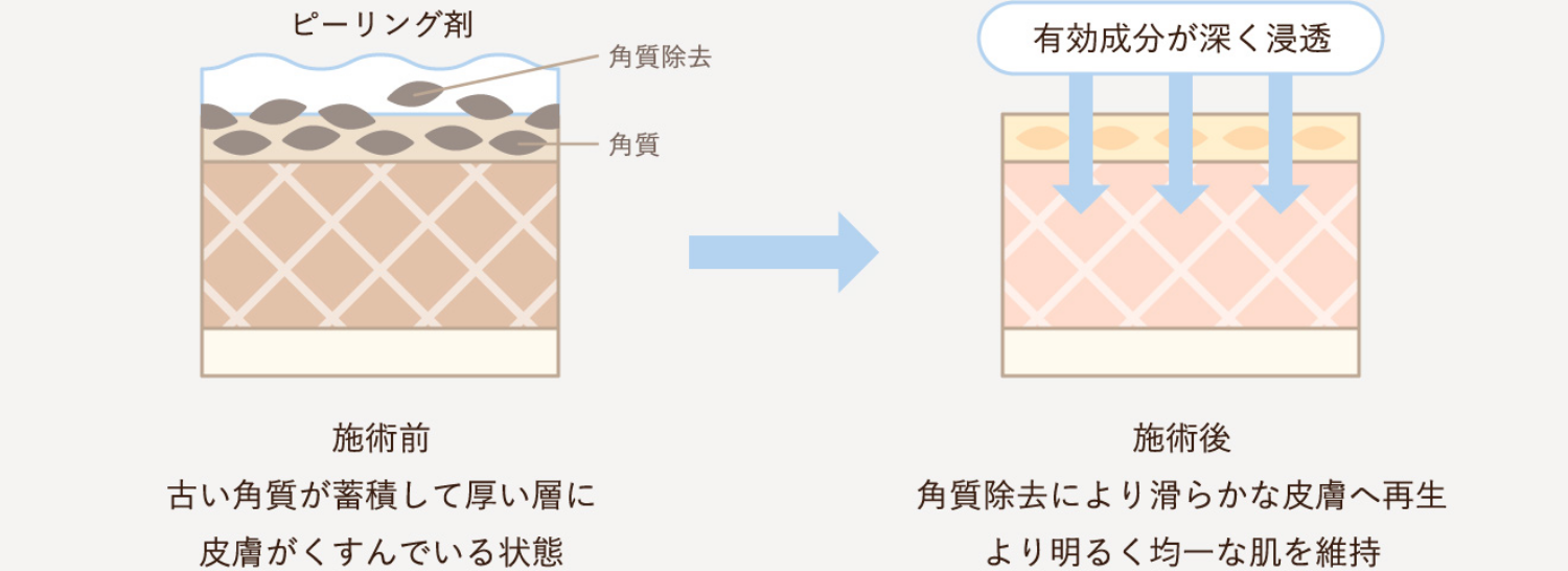 施術前と施術後の図